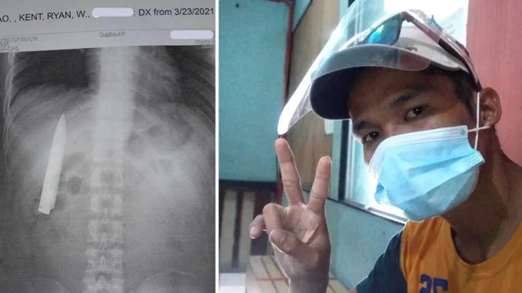 Житель Филиппин год прожил с большим лезвием ножа в груди