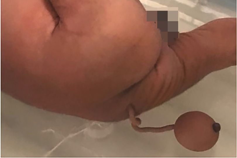 В Бразилии родился младенец со странным хвостом