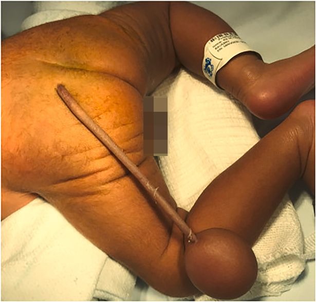 В Бразилии родился младенец со странным хвостом