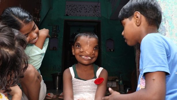 После удаления врожденного «хобота» девочка из Индии осталась с двумя носами
