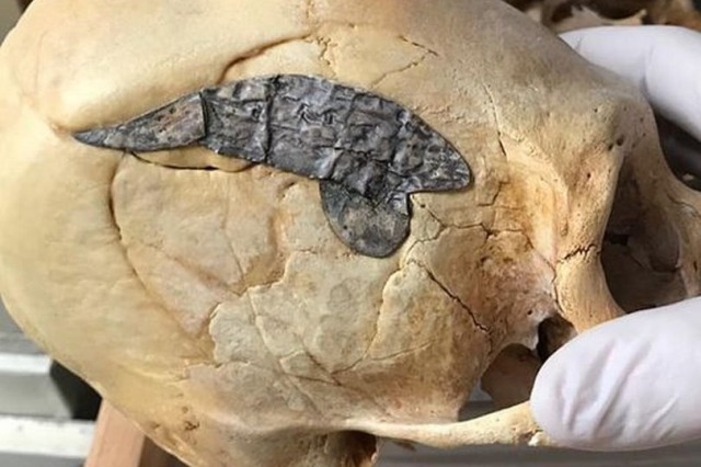 Удлиненный череп с имплантированным куском металла является доказательством передовой хирургии древних