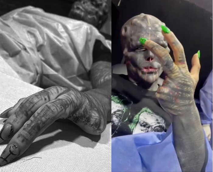 Мужчина удалил себе пальцы, нос, губу и уши в попытках стать инопланетянином