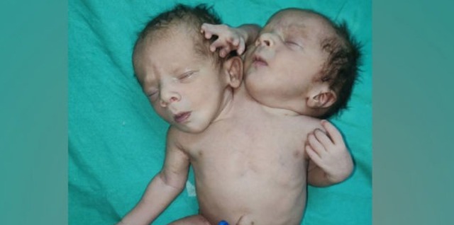 Болезни и мутации - Ребенок с двумя головами и тремя руками родился в Индии