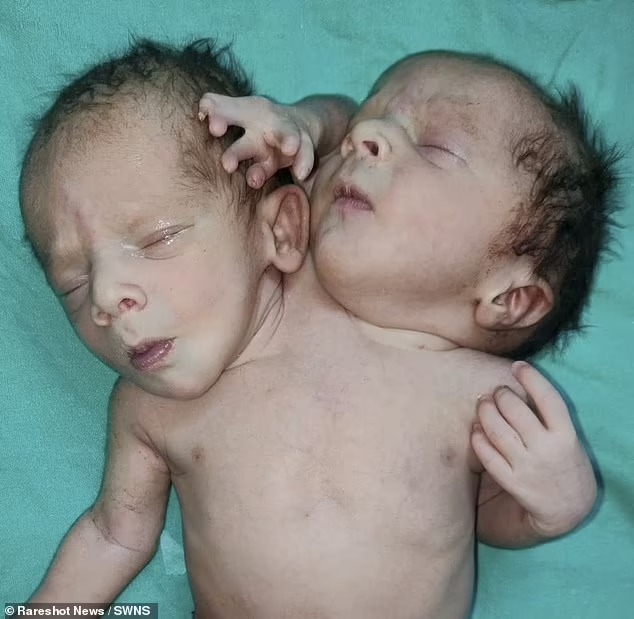 Ребенок с двумя головами и тремя руками родился в Индии