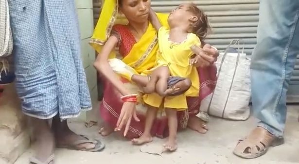 Из живота индийской девочки растут руки и ноги ее близнеца
