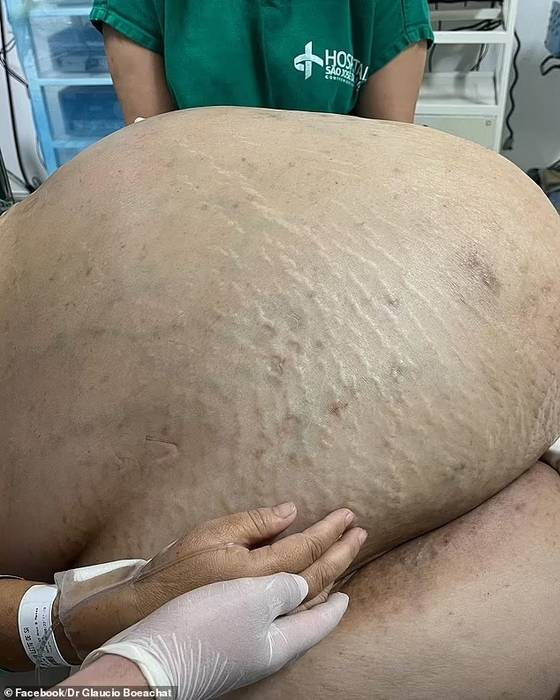 Из живота женщины вырезали 45-килограммовую опухоль