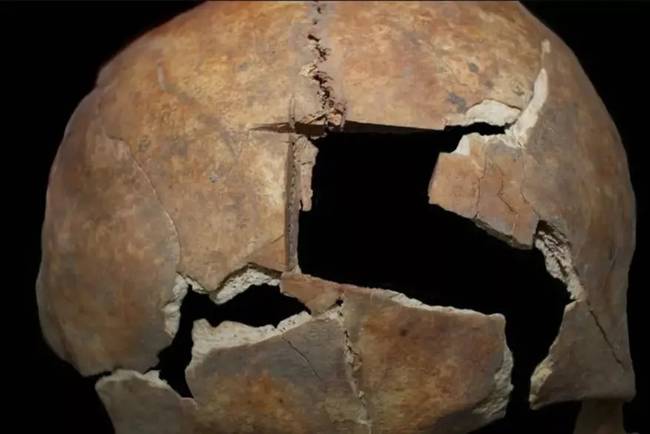 В Израиле найден 3000-летний человеческий череп со следами трепанации