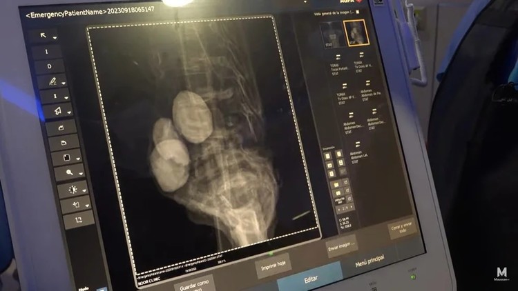 👽 Проведена компьютерная томография «инопланетной женщины» из Перу: Нет признаков склеивания и других посмертных манипуляций
