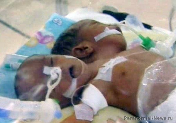 В Индонезии родился двухголовый ребенок