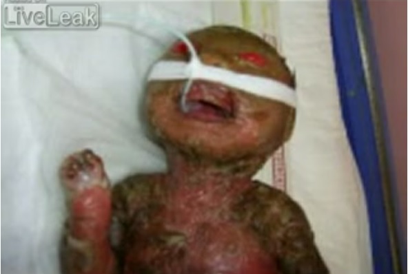 Младенец с тяжелым ихтиозом родился в Саудовской Аравии