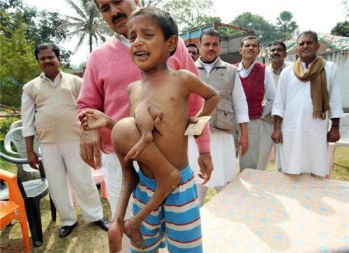 Семилетнего индийского мальчика с близнецом-паразитом возможно все-таки прооперируют