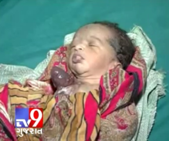 В Индии родился ребенок с сердцем снаружи (видео)