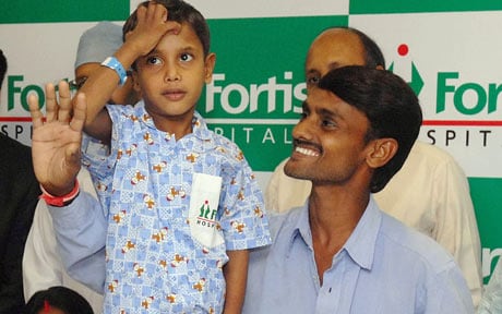 Индийские врачи благополучно отделили от 7-летнего мальчика его близнеца-паразита