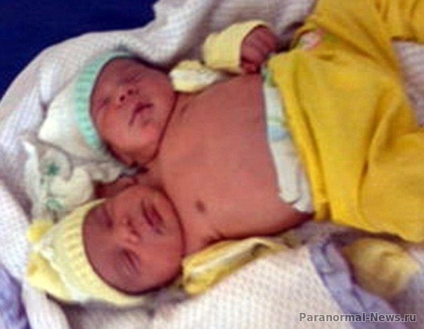 У двухголового ребенка из Бразилии обе головы могут сосать молоко