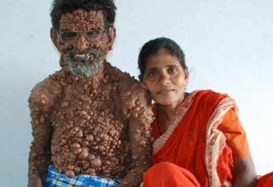 Человек-бородавка из Индии (3 фото)