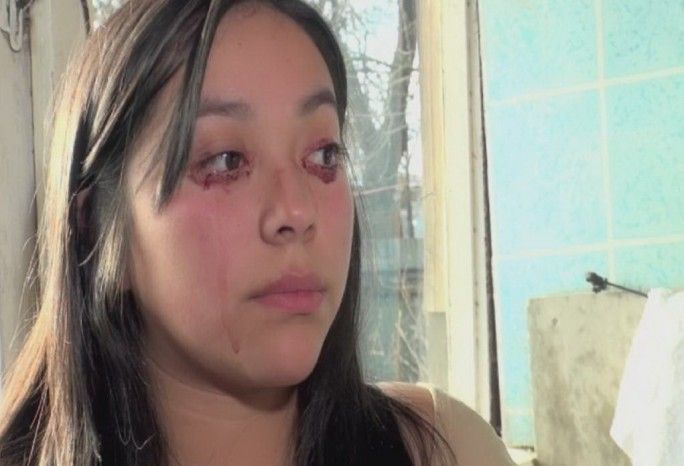 Кровавые слезы у женщины из Чили обескуражили врачей