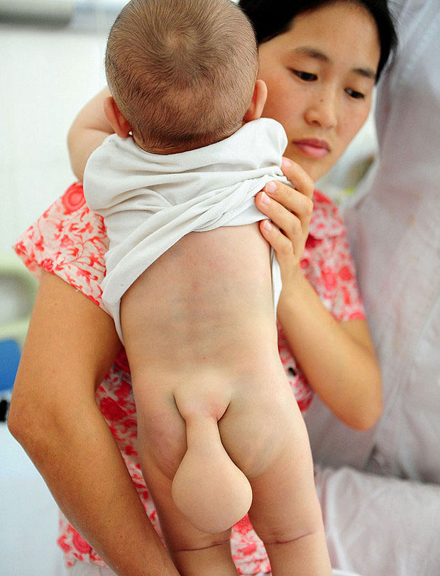 В Китае родился мальчик с хвостом