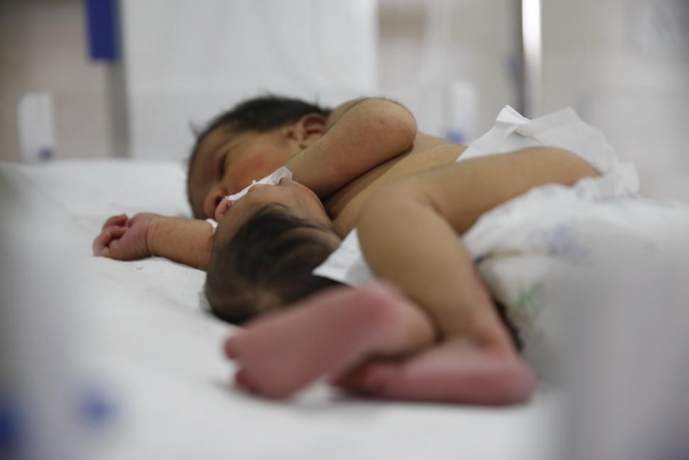 В Индии родилась девочка с второй головой на животе