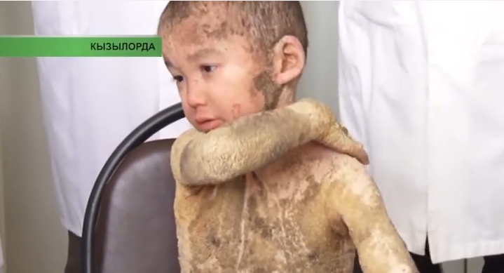 В Казахстане живет мальчик с редкой кожной болезнью
