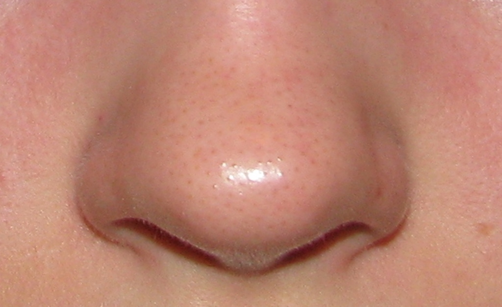 После лечения стволовыми клетками на спине у американки вырос ...нос