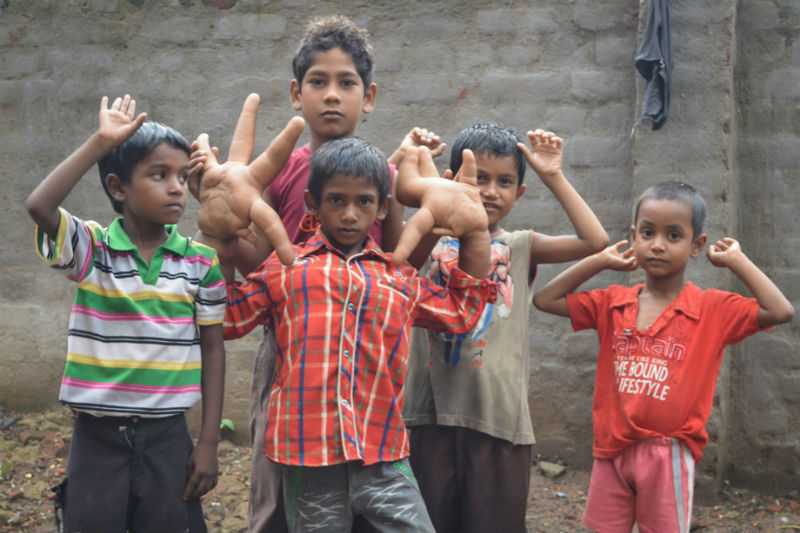 В Индии живет мальчик с огромными руками