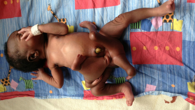 В Уганде родился ребенок с близнецом-паразитом между ног