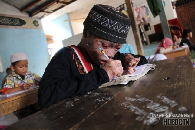 В Индонезии живет мальчик с редким и опасным заболеванием кожи