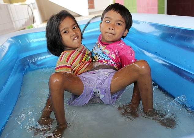 У 7-летних сиамских близнецов из Таиланда одна на двоих нижняя часть тела