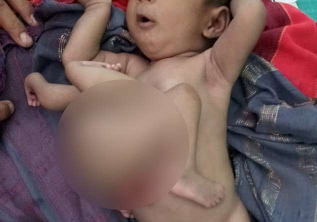 В Индии родился младенец с руками и ногами близнеца-паразита на животе