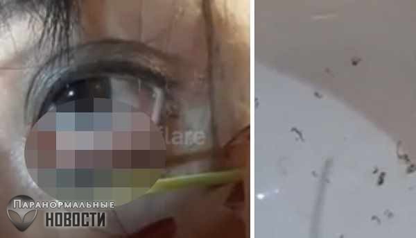 Из глаза женщины вытащили десятки червей-паразитов