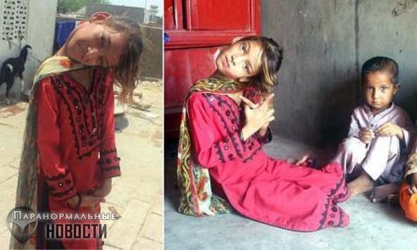 С головой набок: Девочка из Пакистана страдает от необычной травмы