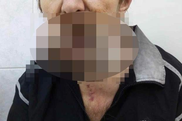 У жителя Кемерово запущенная раковая опухоль поглотила всю нижнюю челюсть (Осторожно, шокирующий контент! 18+)