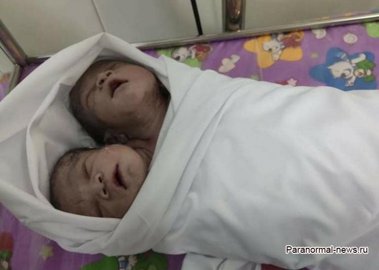 В Мьянме родился мальчик с двумя головами